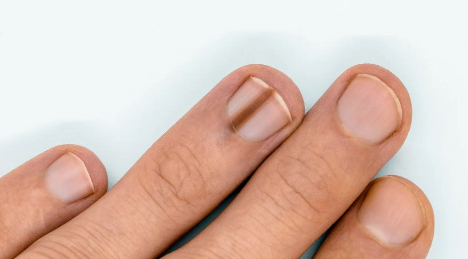 verkleurde nagels bij diabetes