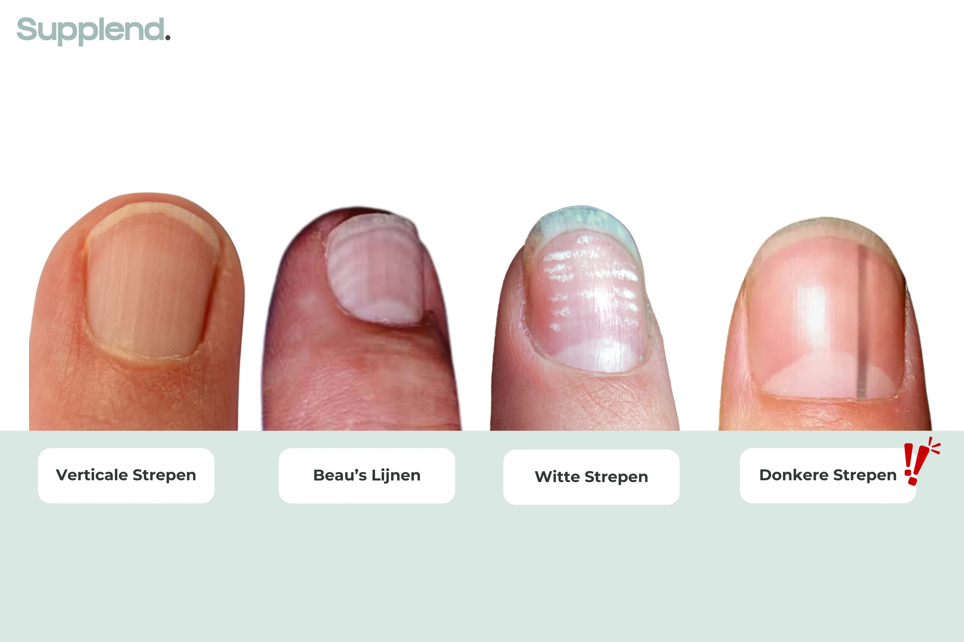 strepen op nagels en geribbelde nagels